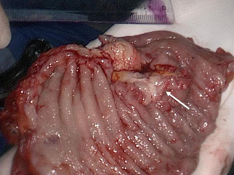 (C) Photograph of gross specimen demonstrates the endometrial lesion (arrow) penetrating the mucous layer of rectal wall.