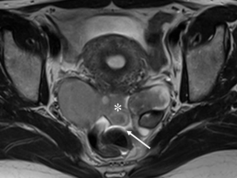 192 Tang et al. Deep infiltrating endometriosis MRI Figure 12 38-year-old woman with DIE.
