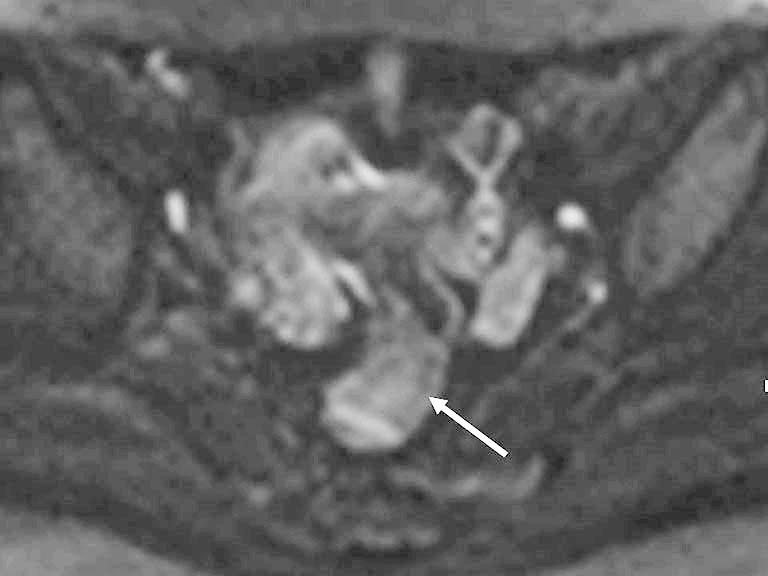 () Sagittal T2-weighted image shows a fan-shaped hypointense mass (arrow) infiltrating the wall of