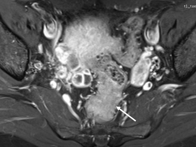 moderate homogenous enhancement; (E) photograph of gross specimen shows a fanshaped lesion infiltrating the