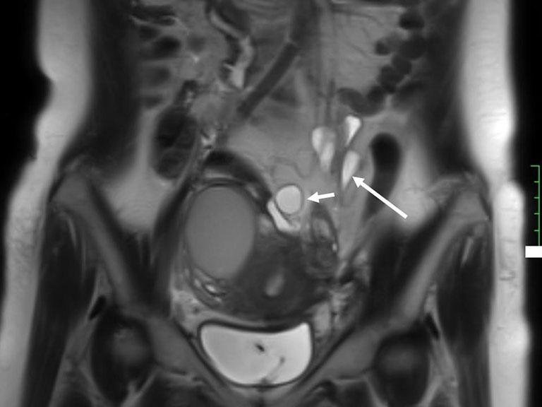 Endometrial cysts (short arrow) are depicted in the pouch of Douglas; () coronal abdominal T2-weighted image