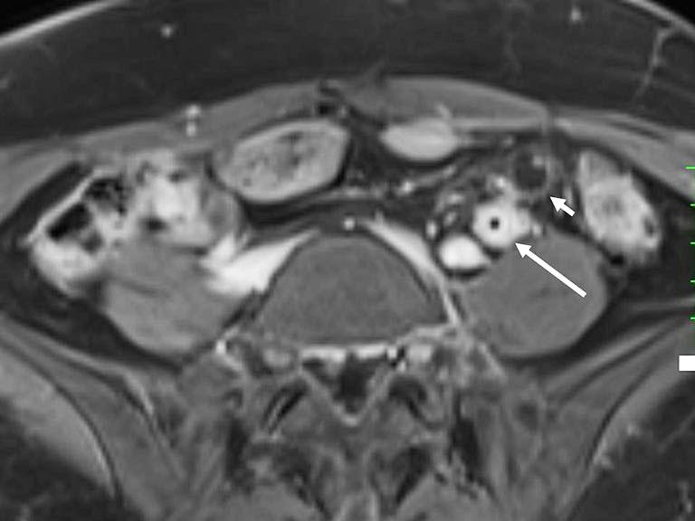 Enlargement or disappearance of T2 shading of an endometrial lesion during follow-up suggests malignant