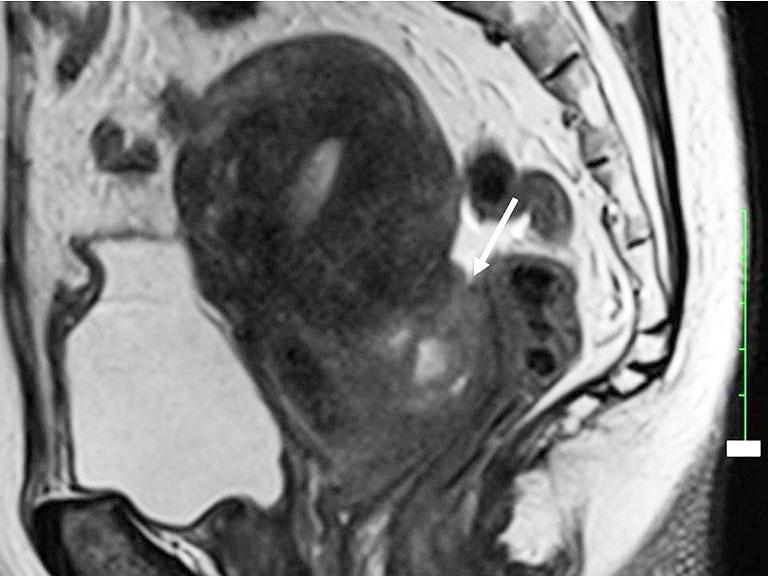 194 Tang et al. Deep infiltrating endometriosis MRI C D Figure 16 41-year-old woman with DIE and malignant transformation of the endometrial lesion in the rectovaginal septum.