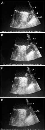 LAA with Contrast Echocardiography in Atrial