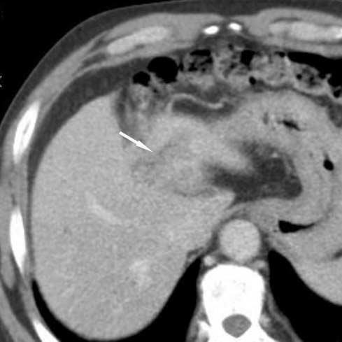 There was no intrahepatic bile duct dilatation. The preoperative differential diagnosis was cholangiocarcinoma based on the enhancement pattern.