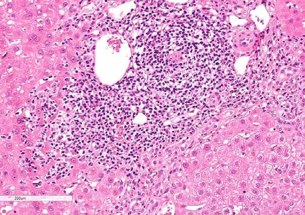 nonsuppurative destructive cholangitis affecting interlobular bile ducts
