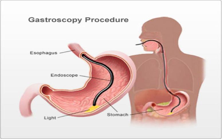 Oesophago-Gastro Duodenoscopy (OGD) / Gastroscopy A gastroscopy is a procedure that allows the doctor to look at the lining of the oesophagus (tube that food passes down), stomach and duodenum (first