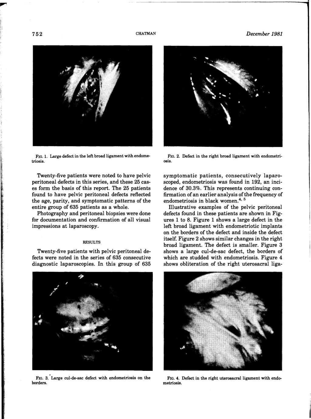 752 CHATMAN December 1981 FIG. 1. Large defect in the left broad ligament with endometriosis.