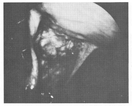 After aspira- tion of the cul-de-sac fluid, multiple endometriotic implants were noted. Biopsy of the inferior edge of the larger defect histologically documented the disease.