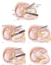 ! incisions are made. The surgeon then removes the appendix with the instruments, so there is usually no need to make a large incision in the abdomen. What is the benefit of laparoscopic appendectomy?