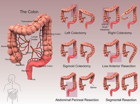 Right Hemicolectomy Part or all of the ascending colon and cecum are removed. The colon is then reconnected to the small intestine Left Hemicolectomy Part or all of the descending colon is removed.