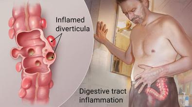 What Are the Symptoms of Diverticulitis? -Pain, which may be constant and persist for several days.