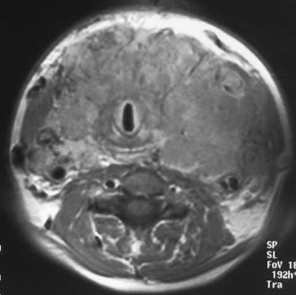 Šerif Bešlić, Selma Milišić: Slikanje magnetskom rezonancom tumora štitne žlijezde Metastazira u kosti (osteolitične) i pluća i lokalni recidivi su češći od limfonodalnih metastaza (8%) (2,6).