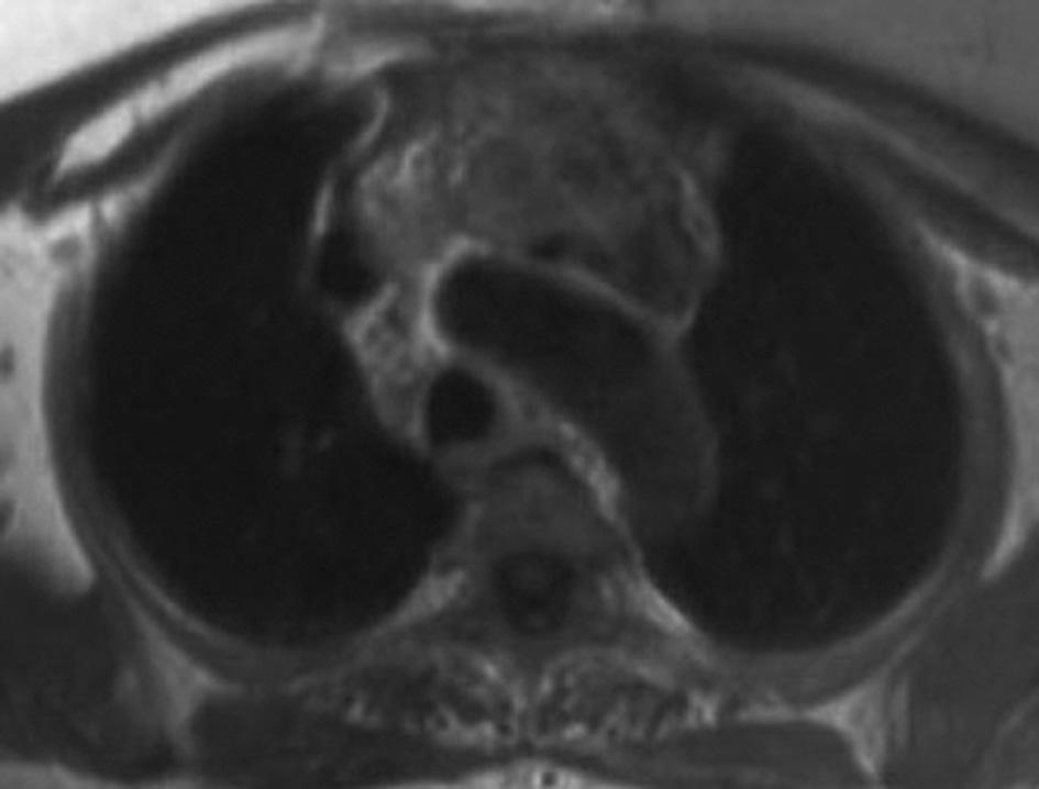 Kod folikularnog karcinoma aksijalna T1W MRI pokaže intermedijaran, a T2W pojačan intenzitet signala, dok T1W MRI poslije primjene kontrasta pokaže difuzno pojačanje (Slika 1 A,B) (1,12). Slika 1.