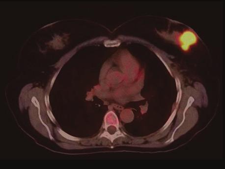Patient had a history of smoking and no family history of breast cancer. Mammography revealed a 4 cmx3.5 cm mass in the left breast and enlarged axillary nodes.