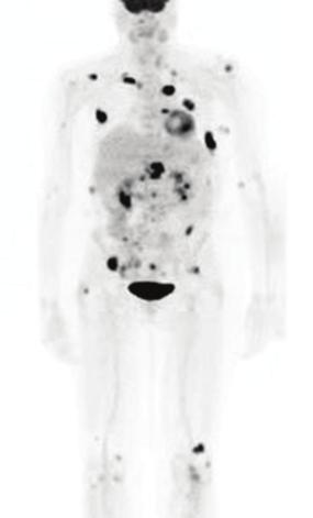 Case Study 2 ease. The PET/CT used for subsequent treatment strategy revealed a worsening mesenteric and peripan creatic adenopathy along with progression of bony metastases.