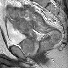T4: tumor invades bladder Axial T2 image
