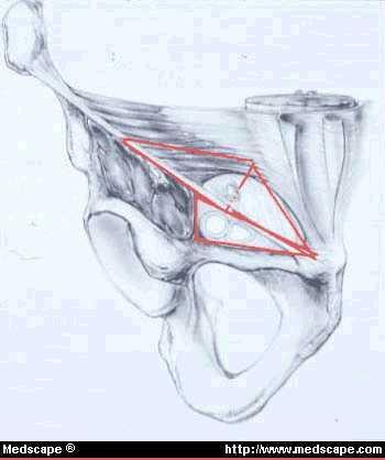 Inguinal ligament 1- folded back ward