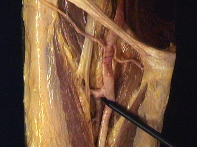 Lacuna vasorum Femoral artery