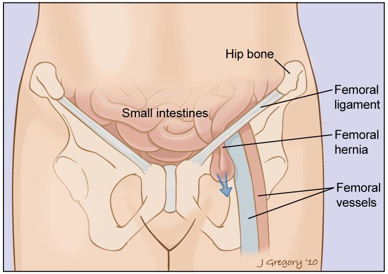 Femoral herniation Inferior to the