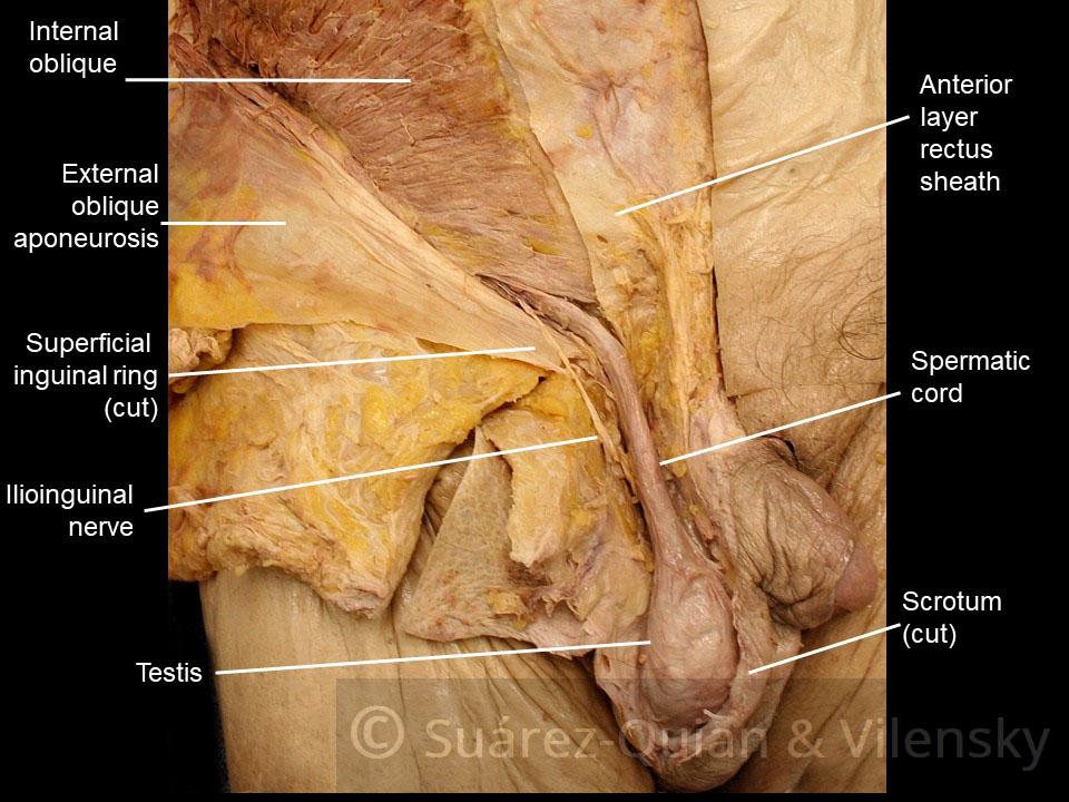 Inguinal canal Roof: Internal oblique and transverse