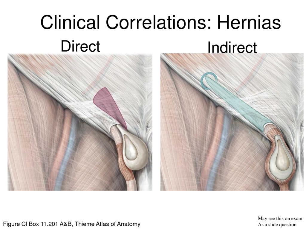 Inguinal herniation Indirect inguinal