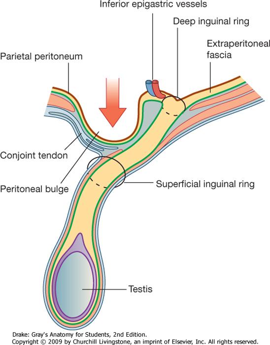inguinal hernia: From the medial inguinal