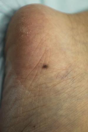 Figure 2. A black macule with a symmetrical border approximately 3 mm in diameter, suggesting the clinical diagnosis of melanocytic nevus. Figure 3.