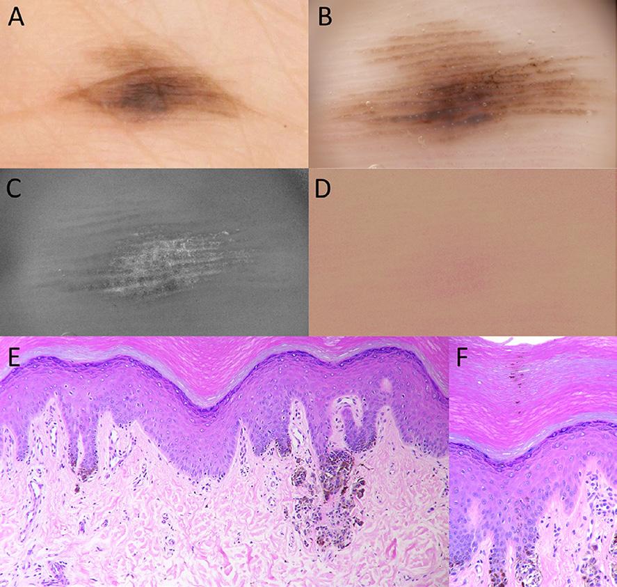 Figure 10. Another case of acral compound nevus. (A) A brown macule that was 12 5 mm in size. (B) Dermoscopy showed blue-gray melanin pigmentation on the ridges and brown pigmentation on the furrows.