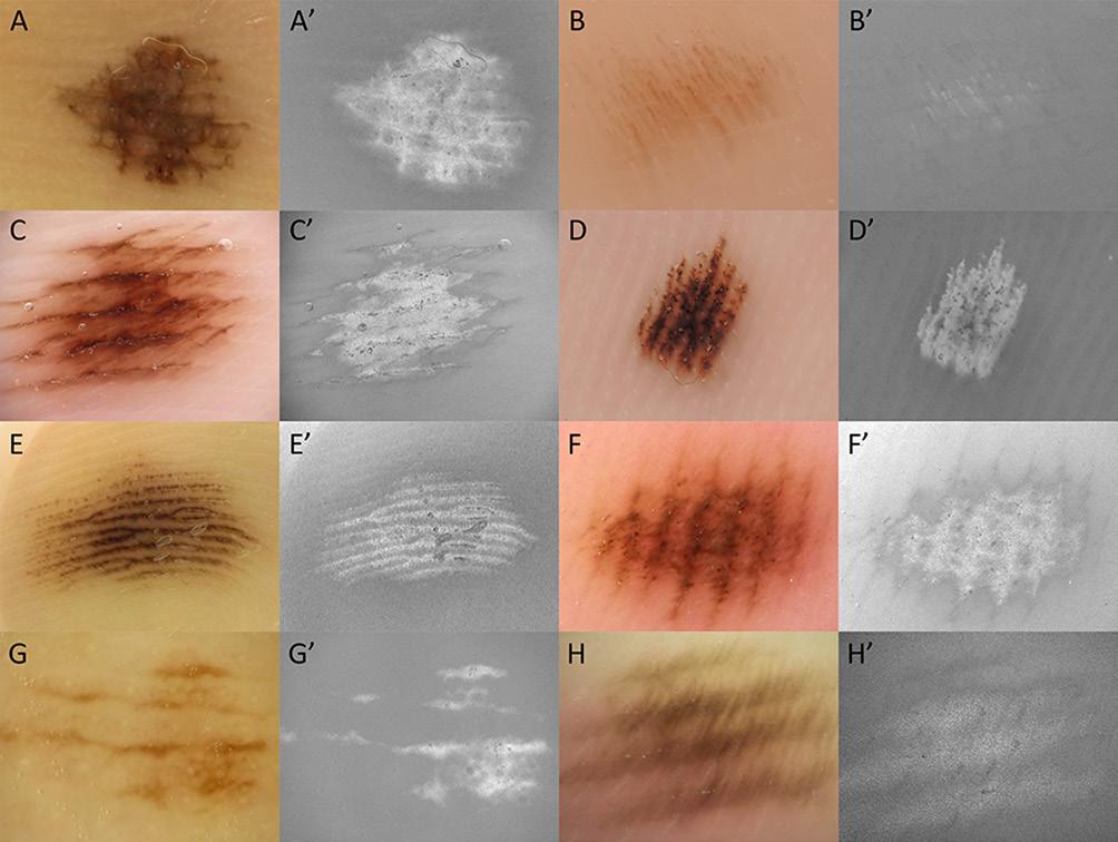 Figure 11. (A H) Dermoscopic images of acral nevi. (A H ) Saturation images of A H. The parallel furrow patterns or fibrillar patterns in acral nevi are composed of saturated melanin pigments.
