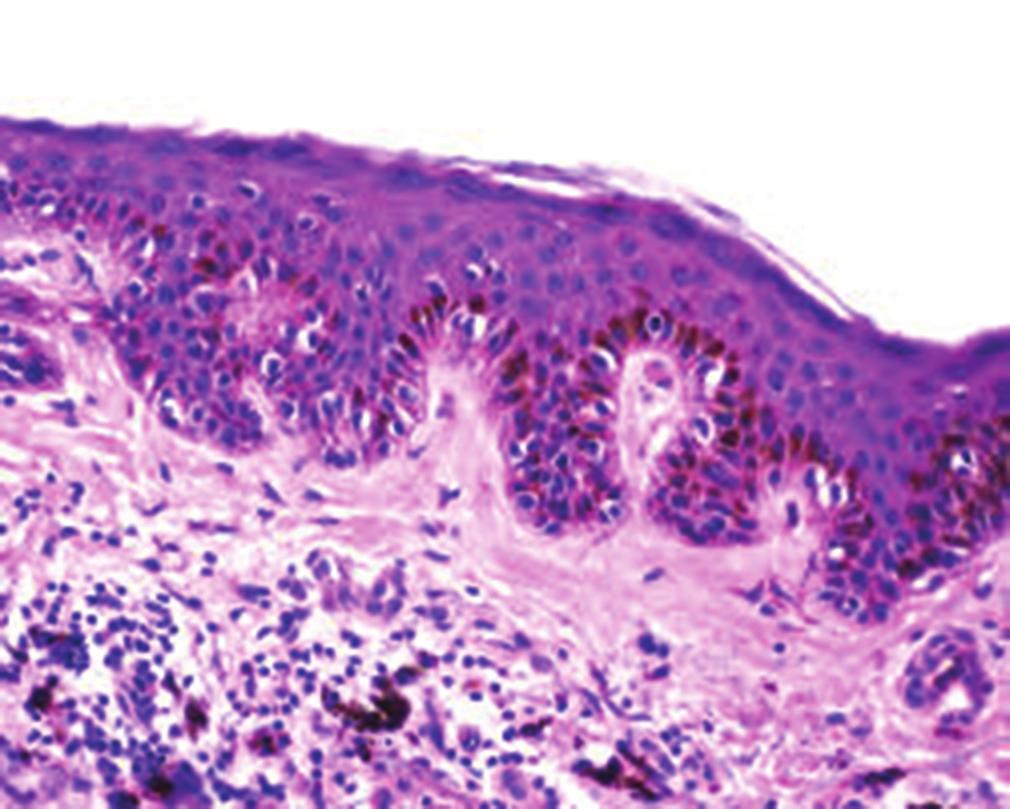 Type C nevus cells in the lower dermis tend to resemble fibroblasts or Schwann cells, because they are usually elongated and possess a spindle-shaped nucleus.