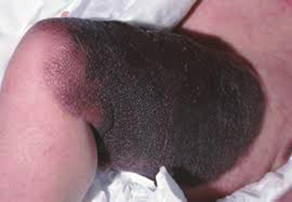 Histologically, most Spitz nevi are compound, 5-10% are junctional and 20% are intradermal lesions (Fig. 2). The Major Diagnostic Criteria Include www.odermatol.com 1.