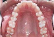 classified as presenting with an Angle Class I malocclusion, in