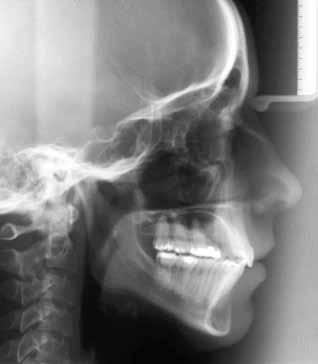 Angle Class I malocclusion with bimaxillary dental protrusion and missing mandibular first molars A B FIGURE 8 - Final lateral cephalogram (A) and cephalometric
