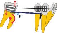 tips mesially in an uncontrolled manner due to the play between archwire and molar tube. As the molar tips further, the archwire contacts the molartube edges, generating an intrabracket M c (Fig. 1B).