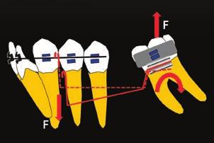 Janakiraman, AlRushaid, Upadhyay, Nanda, and Uribe Fig. 6 Force system of cantilever spring for uprighting lower second molar.