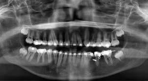 5mm of anchorage loss of the second premolar (Fig. 9). The appliance was then removed, and a panoramic x-ray indicated that the movement was close to translation.