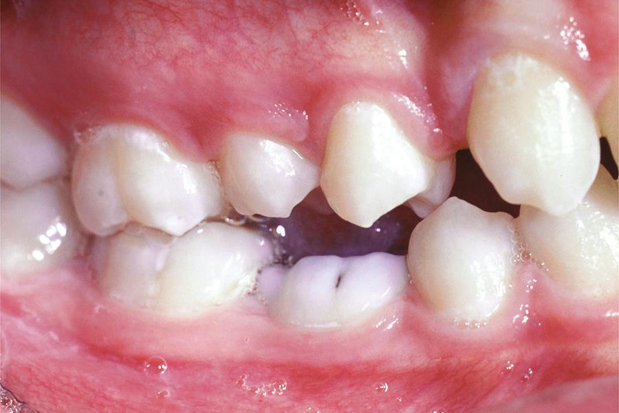 Since the bone levels were flat between the primary and adjacent permanent teeth, the tooth was maintained.