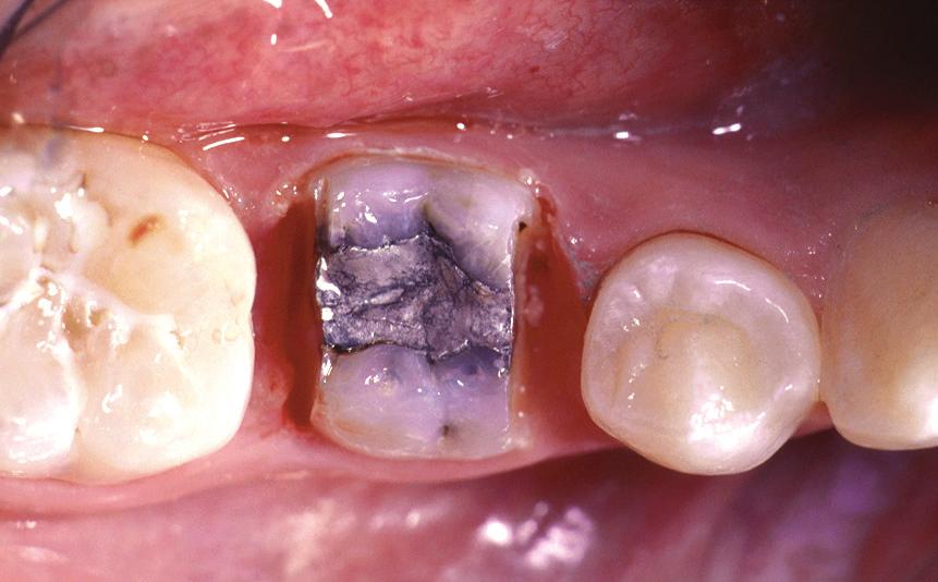 The pulp was not damaged (G) after the space was closed (H) and the posterior teeth were brought into occlusion (H,I). JUNE 2007 VOLUME 3, NUMBER 2 radiograph (Figure 1).