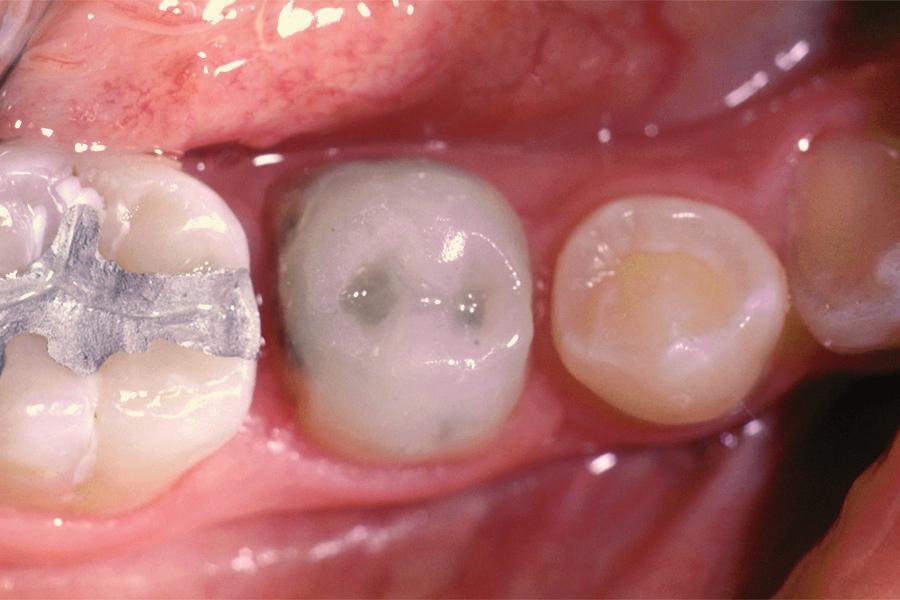 Then, the bur is positioned to follow this line and cut down toward the gingival to remove a wafer of enamel and underlying dentin on both the mesial and distal surfaces (Figure 1).
