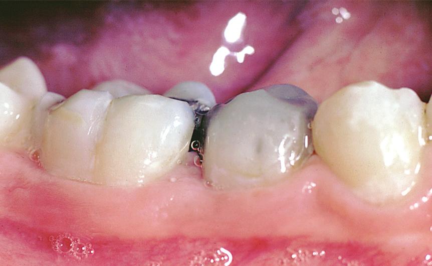 A potential problem of reducing the primary molar in this way is that it leaves exposed dentin on the mesial and distal surfaces of the tooth.
