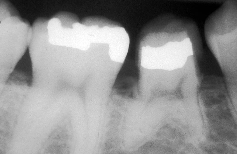 Therefore, in order to prevent decay, a layer of light-cured restorative composite should be applied to the mesial and distal surfaces to protect the primary tooth.