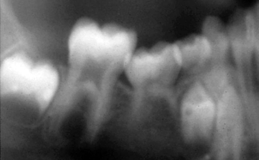 AEID_V3N2_CE_4th 5/10/07 9:04 AM Page 4 A B C D E F G H I Figure 2 This female child was missing her mandibular right and left permanent second premolars, and the primary first and second molars were