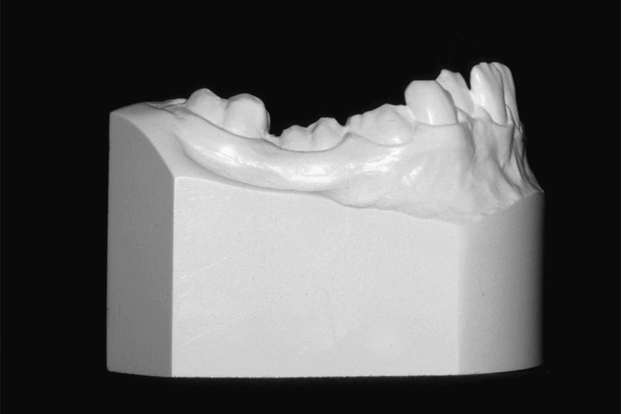 Since the mandibular incisors were positioned lingually relative to the chin (E), the treatment plan involved opening of the second premolar space (F), followed by placement of an implant (G), and