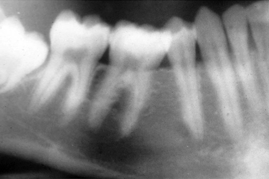 of the typically short primary molar, so it can function with the teeth in the opposing dental arch and prevent supereruption.