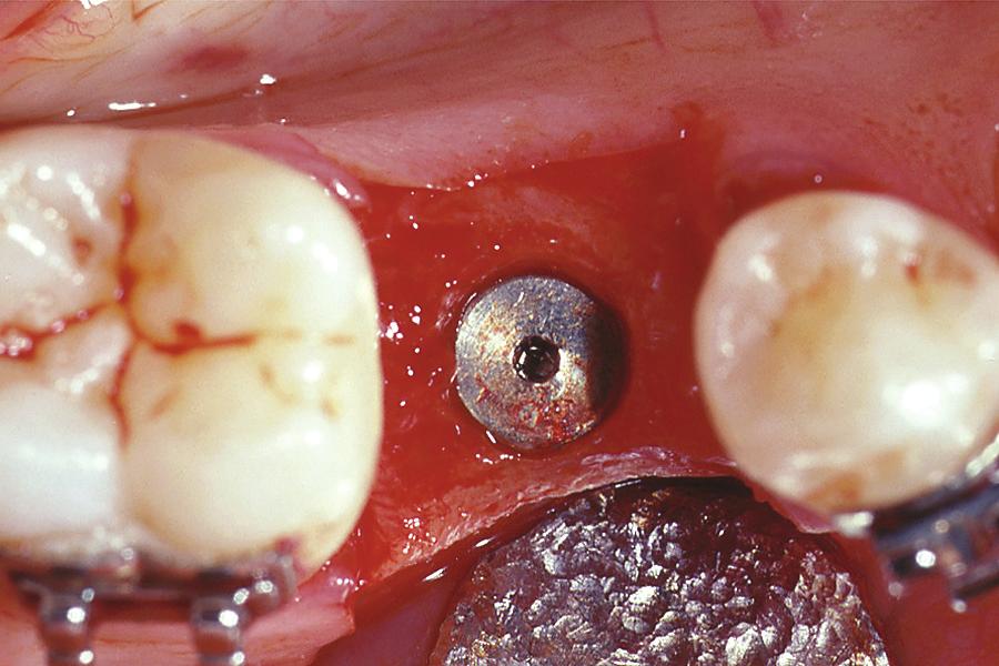 The most reliable indicator of primary molar ankylosis is to evaluate the alveolar bone levels between the primary molar and the adjacent permanent first molar and first premolar.
