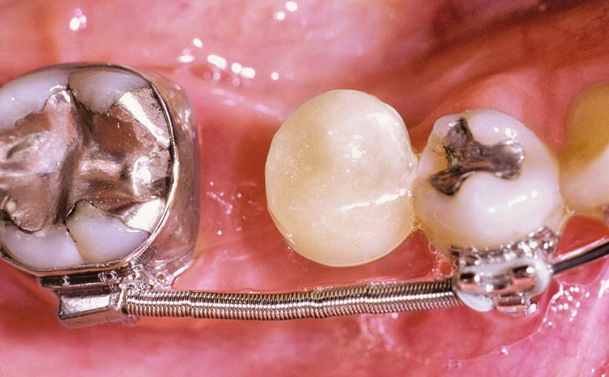 In these situations, it could be advantageous to place a single-tooth implant in the appropriate position prior to the orthodontic treatment.