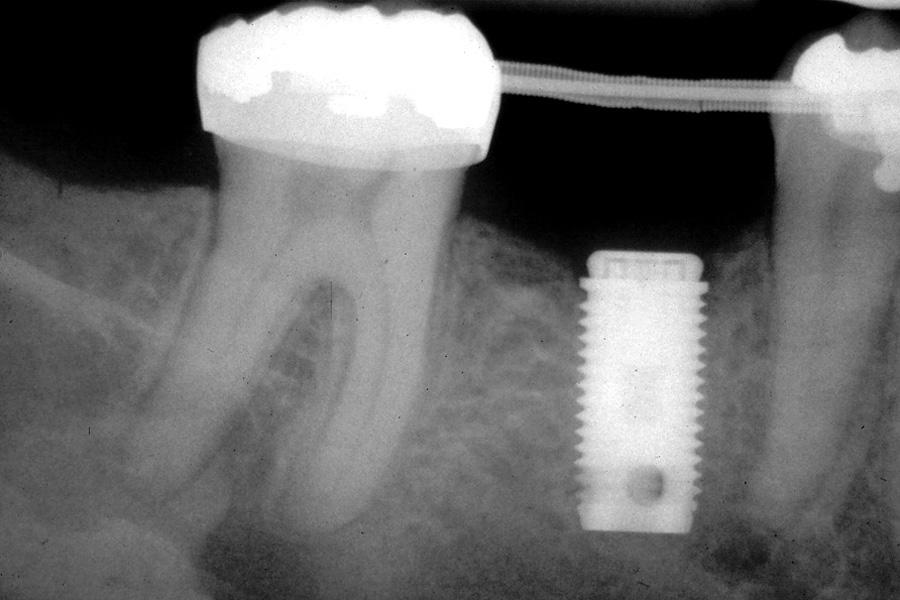 If an implant will be placed in this site, a bone graft may be necessary to provide adequate ridge width and height.