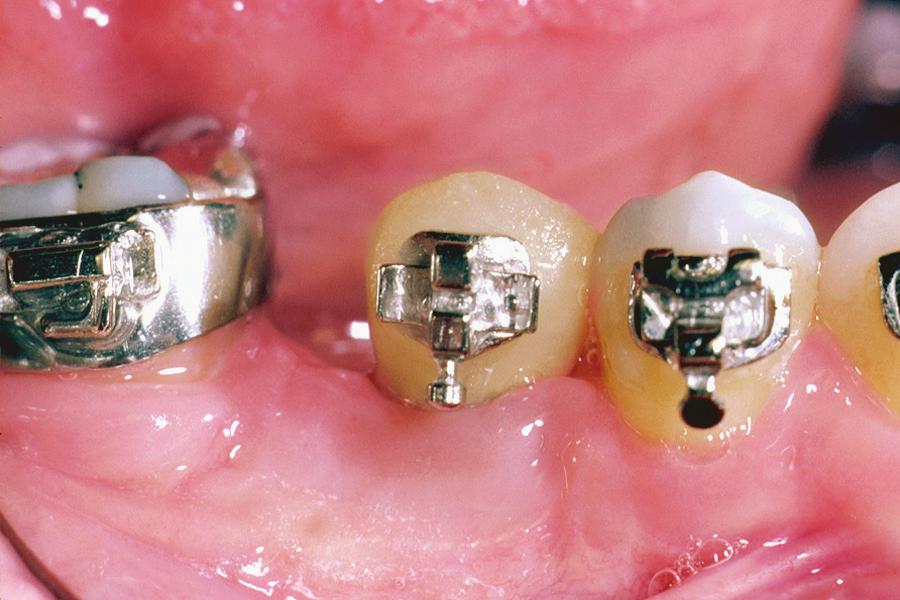 It may be advantageous to push the first premolar into the second premolar position, thereby creating space for the singletooth implant in the first premolar location.