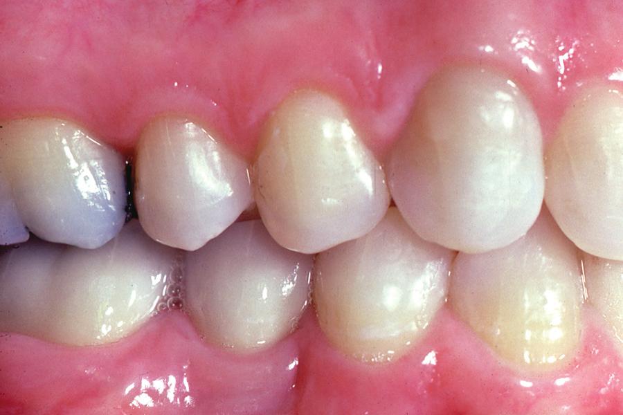 If some drifting of the adjacent teeth has occurred, the resulting edentulous space may be too large for one-tooth replacement, and too small for two-teeth replacement.